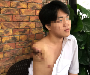 Nam sinh 16 tuổi bị máy tiện cuốn đứt lìa cánh tay trong giờ học thực hành