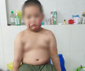 Vụ cha đóng cửa nhà châm lửa đốt khiến 2 con bỏng nặng, bản thân tử vong tại TP.HCM: Người mẹ bị sốc tâm lý, lúc tỉnh lúc mê