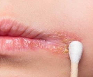 Không quan hệ vẫn mắc bệnh lây truyền qua đường tình dục