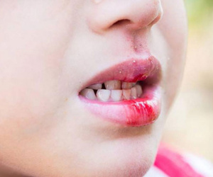 4 triệu chứng điển hình thường xuất hiện trong giai đoạn đầu của bệnh ung thư miệng