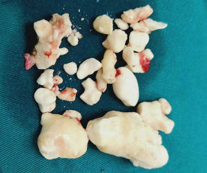 Hà Nội: Nghiện rượu từ cấp 3, người đàn ông có hơn 20 viên sỏi trong tụy