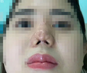 TP.HCM: Cô gái 22 tuổi suy sụp tinh thần, uống 30 viên thuốc tự tử vì bị bác sĩ thẩm mỹ 'dỏm' phá nát mũi