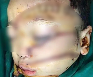Kinh hoàng: Mẹ bỏ đi được 4 tháng, con trai 5 tuổi bị cha chém nát mặt, khâu 300 mũi