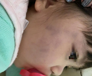Thấy con gái thâm tím hai má, mẹ sốc nặng khi biết giúp việc bạo hành kèm theo lời chửi rủa: 'Không ngủ à? Tao đánh chết mày!'