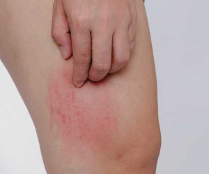 Ngứa 'như điên', tưởng ung thư hoá ra vì... hanh, lạnh
