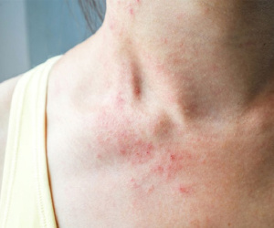 Mùa đông ngứa người như kim đâm, đầu đầy gầu: Không phải do bạn ở bẩn mà chính là do cách tắm của bạn