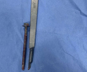 Người đàn ông đến bệnh viện với chiếc ốc vít dài 6cm xoáy vào giữa dương vật
