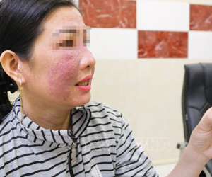 Nhiều chị em bị tai biến do làm trắng da cấp tốc đón Tết
