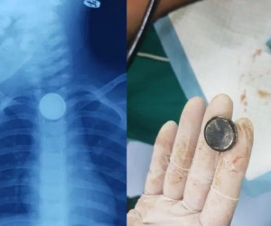 Thực quản của đứa trẻ 2 tuổi bị cháy đen, phải mổ cấp cứu vì ăn phải thứ này