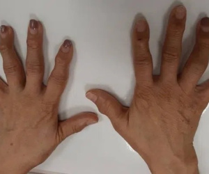 10 ngón tay đau nhức và biến dạng, người phụ nữ điếng người khi bác sĩ thông báo 'Không có thuốc chữa'