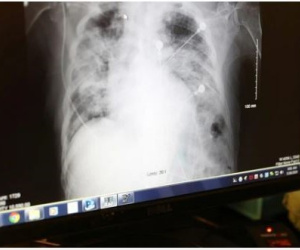 Mỹ: Tử vong sau khi được ghép phổi của người nhiễm... virus SARS-CoV-2