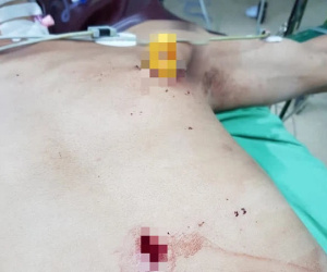 Phẫu thuật cứu sống một bệnh nhân bị dao găm vào ngực