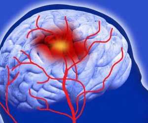 Đột quỵ rất nguy hiểm đến tính mạng: 6 giải pháp để ngăn chặn đột quỵ tấn công