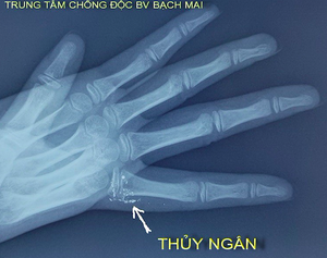 Vẩy nhiệt kế, bé gái nhiễm độc thủy ngân