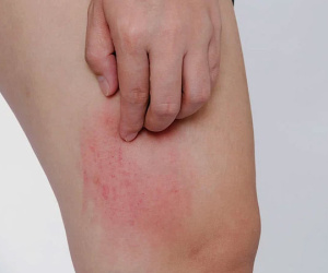 Cô gái 32 tuổi đột nhiên bị mẩn ngứa khắp người, đi khám mới biết đã mắc ung thư gan