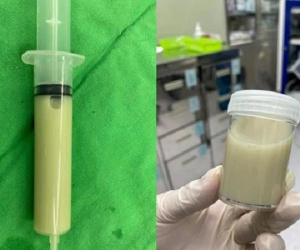 Đau vùng thắt lưng, mệt mỏi kéo dài 1 tháng, người phụ nữ được phẫu thuật hút ra nước tiểu có màu trắng sữa