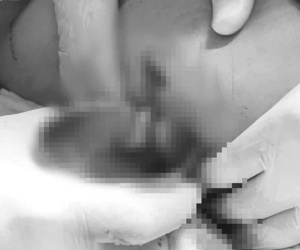 Cô gái 26 tuổi bị 'thối mông' sau khi nhờ bạn thân tiêm filler 'nhập khẩu Mỹ' giá 150 triệu đồng