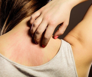 Vì sao nhiều người dễ bị mẩn ngứa vào mùa hè?