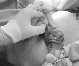 Thối mông, hoại tử ngực, nguy cơ mù 2 mắt và hàng loạt biến chứng kinh hoàng khi thực hiện thẩm mỹ tại 'spa rởm'