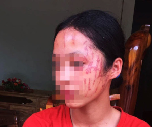 Rùng mình hình ảnh nữ sinh lớp 8 bị 'đàn chị' cào nát mặt: Hé lộ nguyên nhân