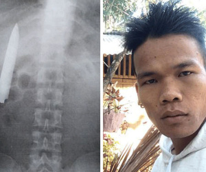 Bị găm lưỡi dao trong người hơn một năm mà không biết