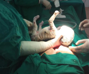 Xót xa bé trai chào đời bị da vảy cá, toàn thân bao phủ vảy trắng với nhiều vết rạn chảy máu