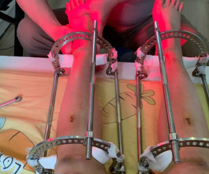 Cô gái Hà Nội giấu bố mẹ đi kéo chân: Không mua quần áo suốt nhiều năm để tiết kiệm, leo lên bàn mổ với ước mơ cao thêm 7cm