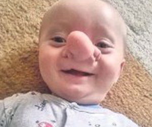'Cậu bé Pinocchio đời thực' sinh ra với chiếc mũi to dị dạng khiến bố mẹ cũng sốc, gây bất ngờ với diện mạo sau ít năm