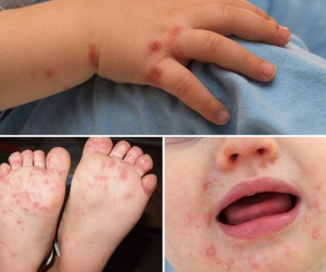 28 quận, huyện của Hà Nội đã xuất hiện dịch tay chân miệng