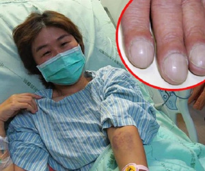Bị ung thư phổi, cô gái khóc nấc khi lỡ chủ quan bỏ qua dấu hiệu nguy hiểm này ở ngón tay