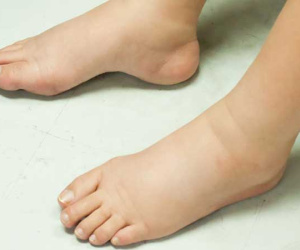 Chân sưng phù cảnh báo bệnh gì?