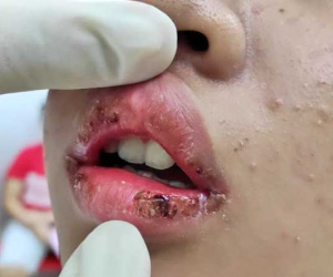 Mua son quảng cáo trên facebook giá 5.000 đồng/hộp về dùng, thiếu nữ 15 tuổi sưng vù môi và đóng vảy khô đen