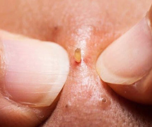 Vì sao nhiều người lại nghiền xem nặn mụn đến vậy dù vừa xem vừa nổi da gà?