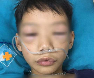 Bé trai 10 tuổi sốc phản vệ phù nề vùng môi và mí mắt 2 bên sau uống thuốc tự mua chữa ho, sốt