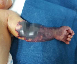 Bé trai sinh non tay sưng phù, đỏ tím vì hội chứng hiếm gặp