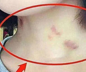 Bà mẹ phát hiện 'vết bầm tím lạ' trên cổ con gái, hoảng hốt báo cảnh sát, sự thật đằng sau lại khiến người lớn ngượng tím mặt
