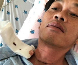 NÓNG: Nghệ sĩ Hoài Linh phẫu thuật vì bị u ác tuyến giáp cách đây vài tháng