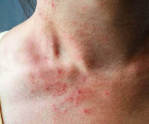 20% bệnh nhân ung thư có triệu chứng ngứa: Nếu 3 vị trí này trên cơ thể cảm thấy ngứa liên tục, bạn nên đi khám khẩn cấp