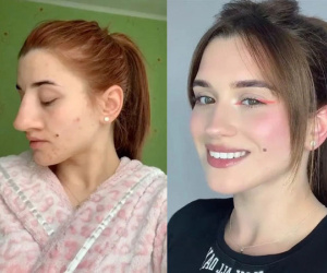 Cô gái khoe sửa mũi thành công thu hút 13 triệu lượt xem, dân mạng chẳng khen xinh mà phát hiện điểm bất thường khó tin