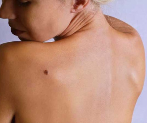 Chuyên gia hướng dẫn các bước kiểm tra da để phát hiện ung thư sớm