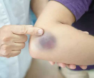 Vết bầm tím trên cơ thể, tưởng đơn giản nhưng có thể là dấu hiệu cảnh báo bệnh lý nguy hiểm