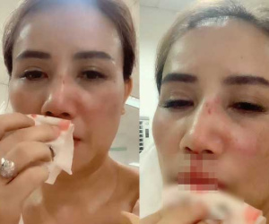 Cô Xuyến (Về Nhà Đi Con) bị gãy xương sau cú đấm hung tợn của chồng thứ 4, hé lộ tình trạng hiện tại