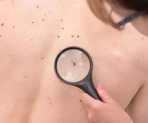 Nốt ruồi là bình thường nhưng nếu 'mọc' ở 4 bộ phận này thì cần hết sức chú ý, có thể trở thành ung thư bất cứ lúc nào