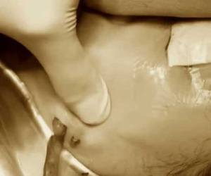 Cô gái 24 tuổi bị nhiễm trùng vùng mặt nghiêm trọng sau 3 năm tiêm filler