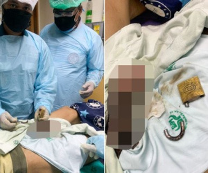 Đeo khóa vào vùng kín để 'đổi gió' rồi làm mất chìa, người đàn ông biến dạng của quý vĩnh viễn sau 2 tuần mắc kẹt
