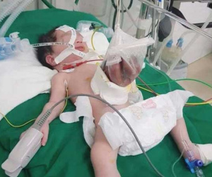 Bé sơ sinh 2kg có nội tạng nằm ngoài ổ bụng, bác sĩ đã làm được điều kì tích sau 2 lần phẫu thuật
