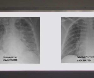 So sánh ảnh chụp phổi của bệnh nhân COVID-19 đã tiêm và chưa tiêm vaccine, phát hiện điều kinh ngạc