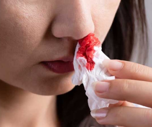 Bị chảy máu cam, ngửa cổ hay nhét giấy vào mũi mới đúng? Hóa ra trước giờ chúng ta vẫn làm sai cách đấy