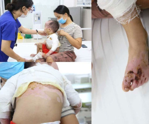 Bị đổ cả nồi chè đỗ đen nóng vào người, bé 2 tuổi bị sốc bỏng độ 2-3