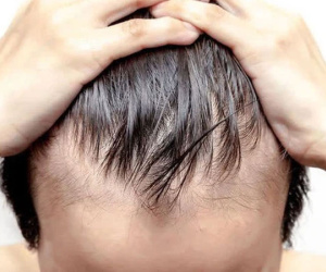 Cẩn thận nếu đầu tóc bạn xuất hiện 6 dấu hiệu này: Bết, thưa, rụng hay bạc sớm không đáng sợ bằng điều này